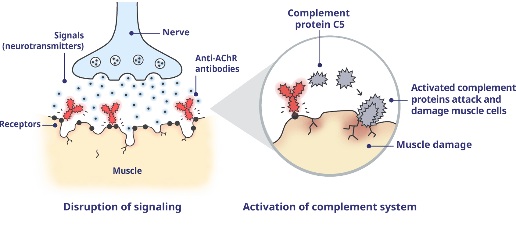 A neuromuscular junction (NMJ) impacted by gMG with activated complement proteins.