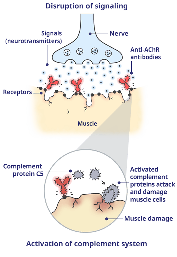 A neuromuscular junction (NMJ) impacted by gMG with activated complement proteins.
