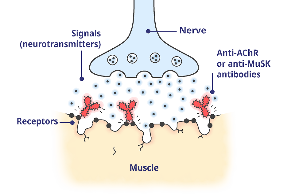 A neuromuscular junction (NMJ) impacted by gMG.