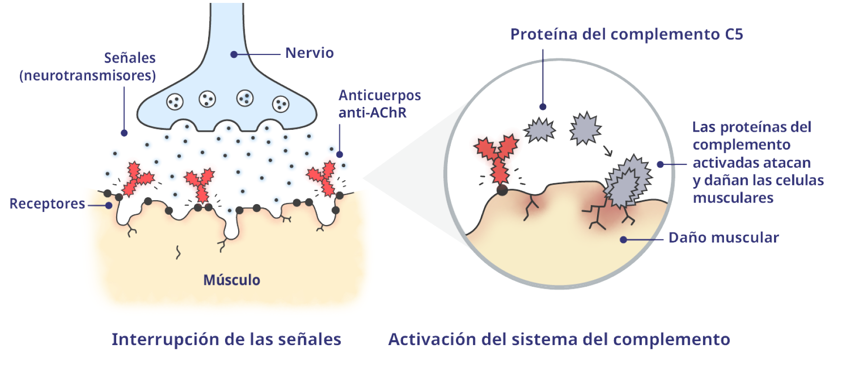 Unión neuromuscular (UNM) afectada por la MGg con proteínas del complemento activadas.