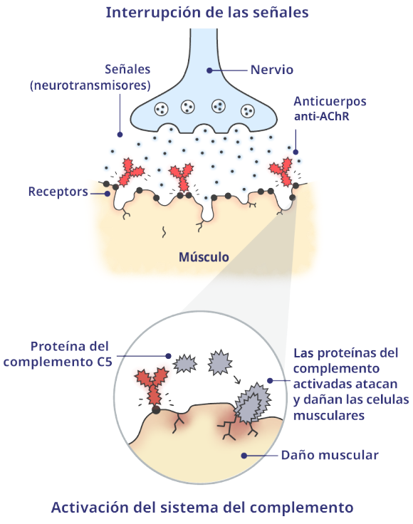 Unión neuromuscular (UNM) afectada por la MGg con proteínas del complemento activadas.