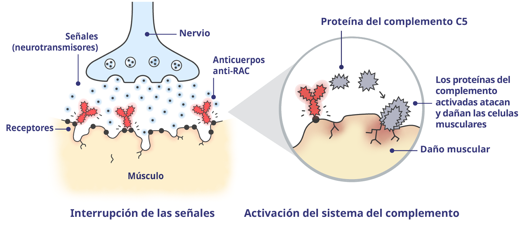 Unión neuromuscular (UNM) afectada por la MGg con proteínas del complemento activadas.