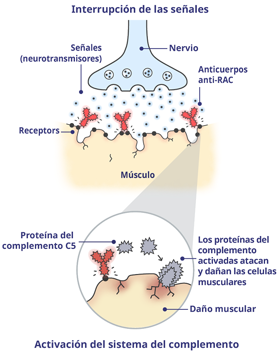 Unión neuromuscular (UNM) afectada por la MGg con proteínas del complemento activadas.