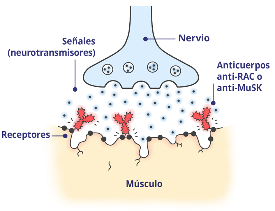Unión neuromuscular (UNM) afectada por la MGg.