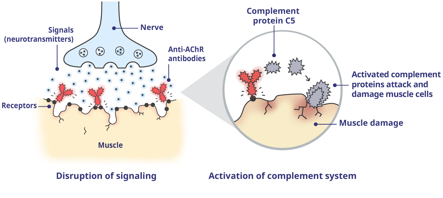 A neuromuscular junction (NMJ) impacted by gMG with activated complement proteins.