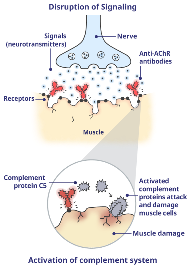 A neuromuscular junction (NMJ) impacted by gMG with activated complement proteins.