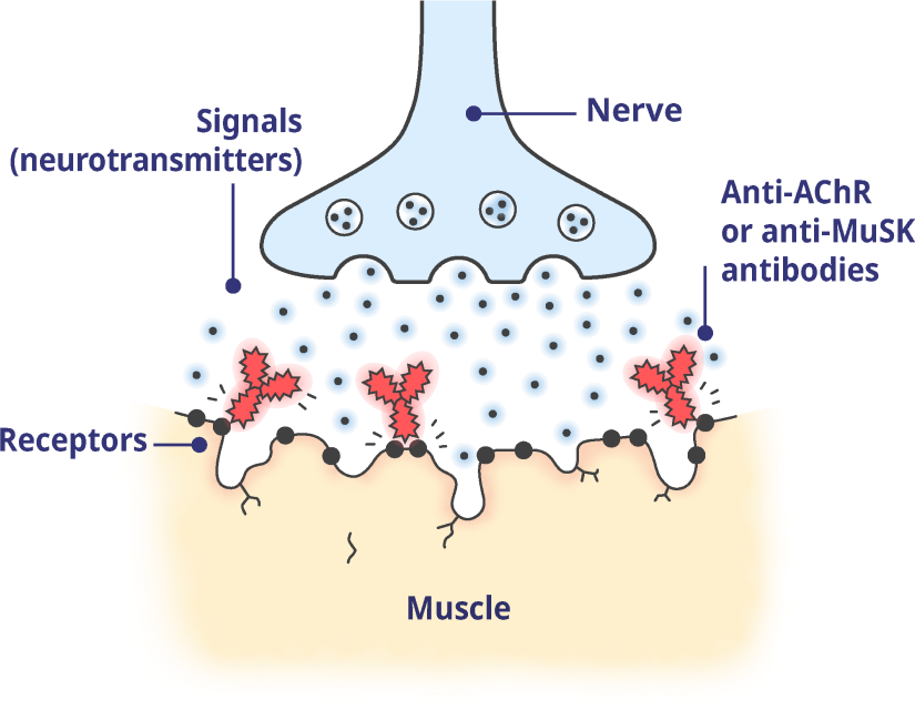 A neuromuscular junction (NMJ) impacted by gMG.